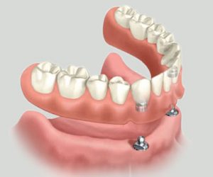 Protez Diş Tedavileri