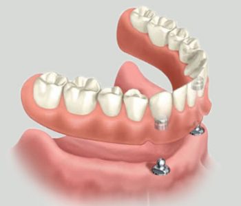 Protez Diş Tedavileri