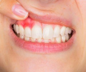 Diş Eti Hastalıkları ve Tedavisi (Periodontoloji)