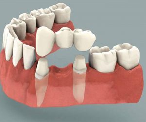 İmplant Diş Tedavisi