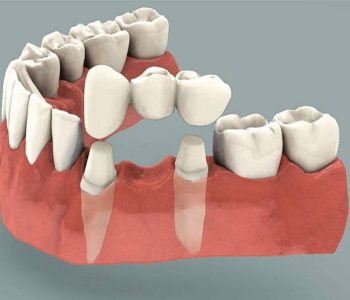İmplant Diş Tedavisi