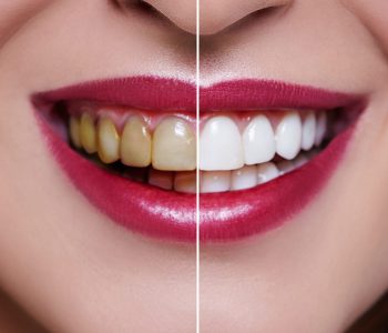 Diş Beyazlatma (Bleaching)