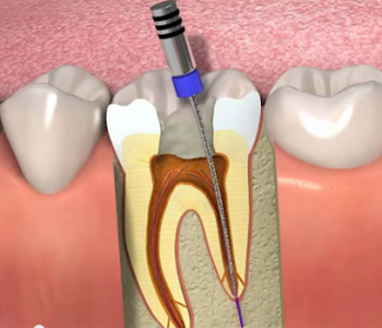 Kanal Tedavisi (Endodonti)